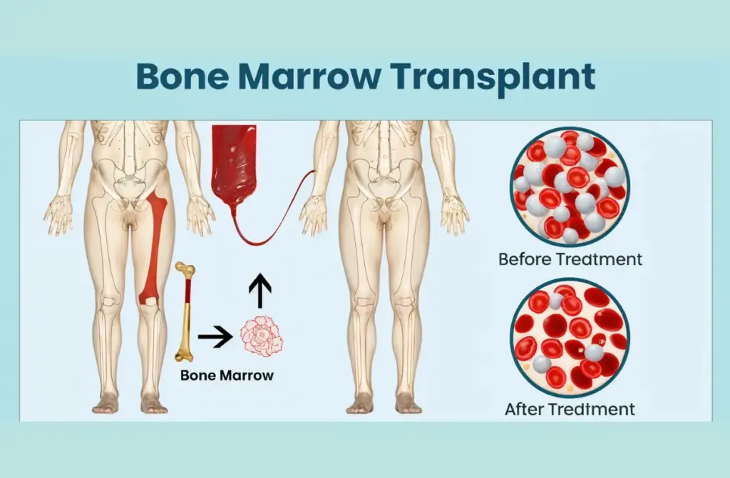 Best Bone Marrow Transplant Hospital in Tamilnadu